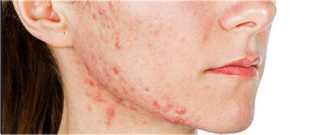 Why Does Stress Cause Acne Health Information World