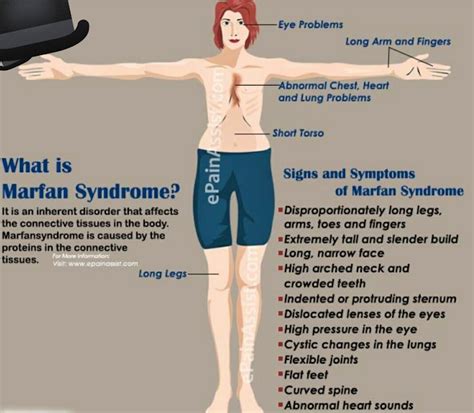 Marfan Syndrome Marfan Syndrome Symptoms Syndrome My XXX Hot Girl