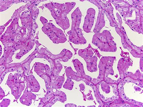 Pathology Outlines Oncocytic Papillary Renal Cell Carcinoma