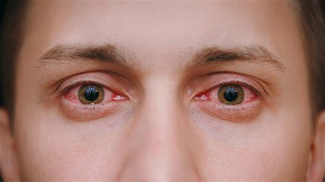 19 Causas De Los Ojos Rojos Y Tratamiento Con Gotas All About Vision