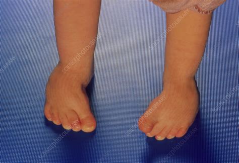 Infant With Club Feet Talipes Equinovarus Stock Image M3500146