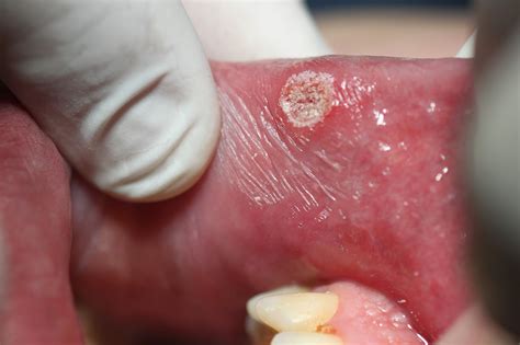 Pain Relief Of Aphthous Ulcers By Lasers Literature Review Dental News