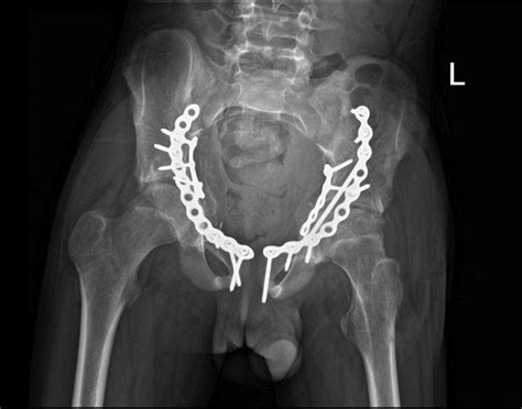 Bilateral acetabular fractures induced by an epileptic seizure in a