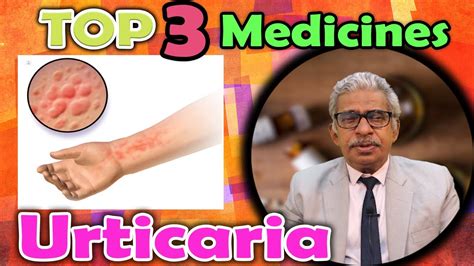 Top 3 Homeopathy Medicines For Urticaria Dr P S Tiwari Youtube