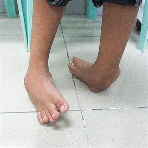 Clubfoot Treatment How Parents And The Internet Transformed Clubfoot