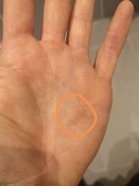 Lump On Palm Makes Snatches Very Uncomfortable Rkettlebell