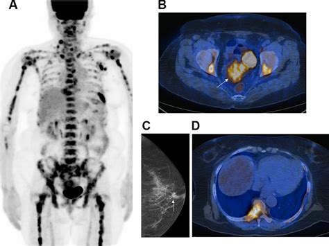 Role Of 18f Fdg Petct In Patients Without Known Primary Malignancy