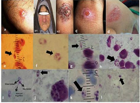 Clinical Appearance Of Cutaneous Leishmaniasis Cases In Four Districts Download Scientific