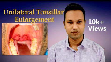Unilateral Tonsillar Enlargement Aetiologies And Evaluation Youtube