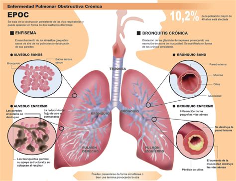 Immunotec Yucatan Enfisema Pulmonar Epoc Bronquitis