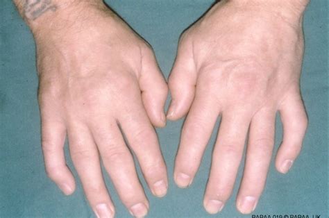 What Questions Should I Ask About Psoriatic Arthritis