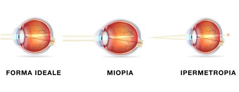 Cos La Miopia Problemi Visivi Tecnologie Visione