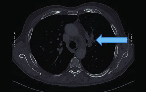 The Chest Computerized Tomography Scan Showed A Infiltrating Tumor Mass