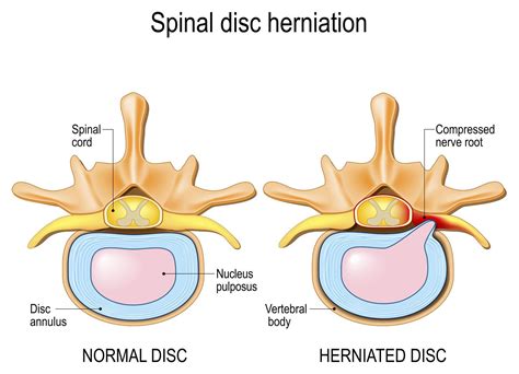 chiropractic care for herniated disc dr sima goel