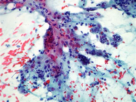 Breast Cytopathology Cellnetpathology