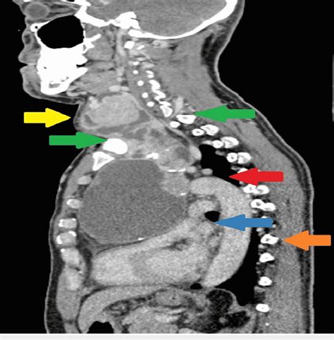 Ct Sagittal Plane Of The Goiter Extending Below Thoracic Inlet Into