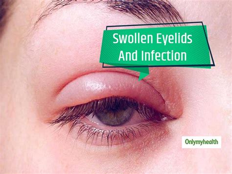 Swollen Eyelid Causes Treatment And More