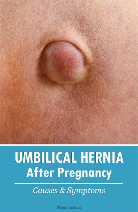Umbilical Hernia After Pregnancy Everything You Should Be Aware Of Posts Umbilical Hernia