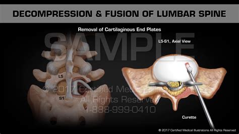 Decompression And Fusion Of Lumbar Spine Youtube