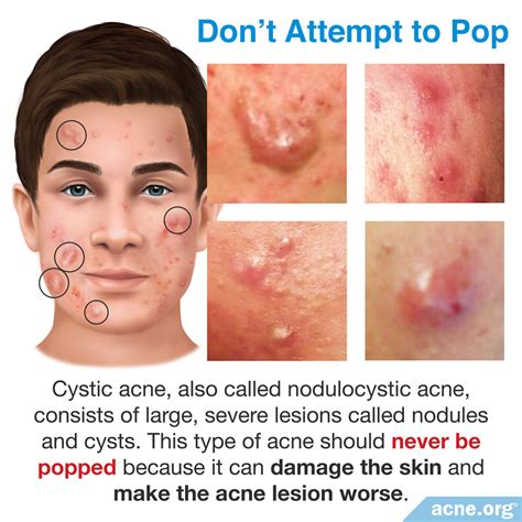 Should You Pop Cystic Acne Acne Org
