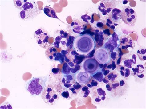 Pathology Outlines Cryptococcus Neoformans Gattii