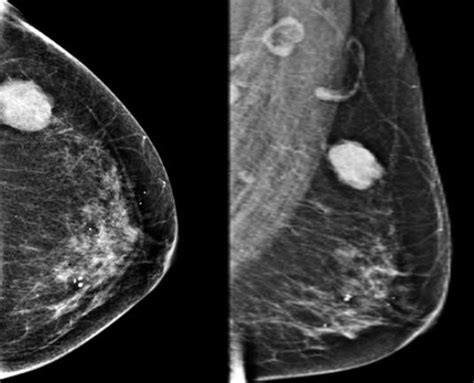 2 Mamografia Pruebas Imagen Pacientes Cancer Mama Ocronos Editorial