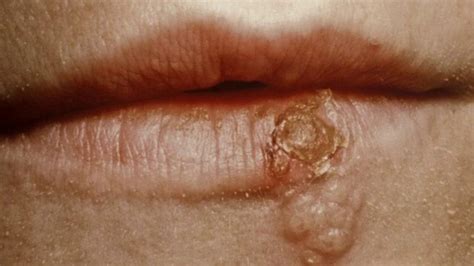 Toutes les femmes connaissent un jour une infection urinaire. Replay Allô docteurs, Allô docteurs Herpès : comment s'en ...