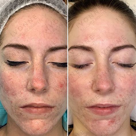 What Does Microneedling Do For Your Skin Microneedling Is Used To