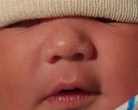 Skin Newborn Nursery Stanford Medicine