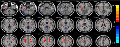 Fmri Scans Of Patients With Benign Epilepsy With Centrotemporal Spikes