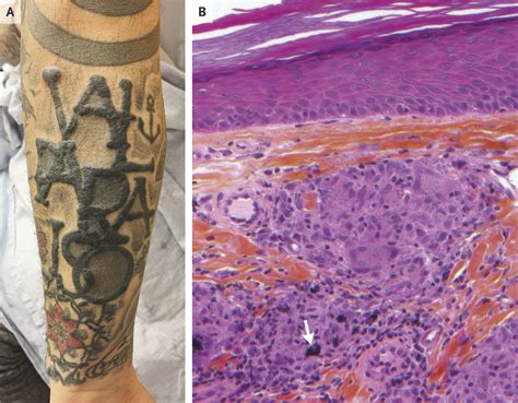 Sarcoidal Reaction In A Tattoo Nejm