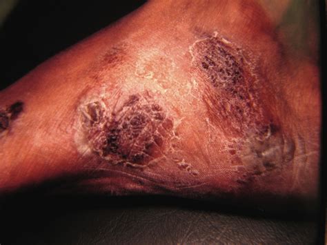 What You Should Know About Lichen Planus