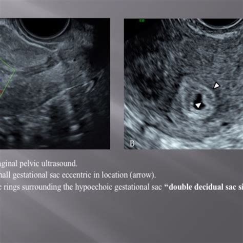 Transvaginal Pelvic Ultrasound A Intrauterine Small Gestational Sac