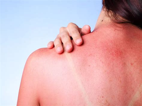 6 Simple Quick Ways To Treat Sunburn