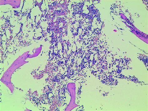 Histological Examination Of First Bone Marrow Aspiration Showing Pure Download Scientific