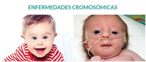 Enfermedades Cromosómicas Definición Y Tipos De Alteraciones