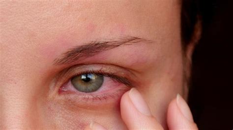 Przekrwione Oczy Przyczyny I Leczenie Czerwonych Oczu Choroby Polki Pl