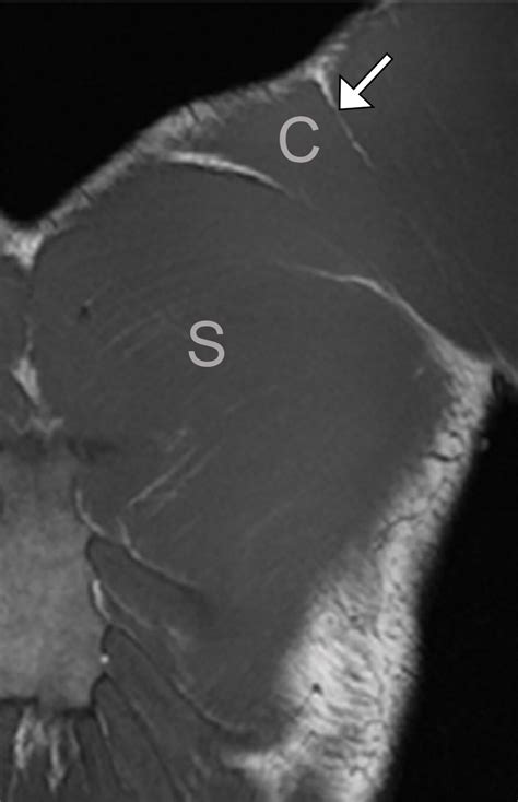 Us And Mr Imaging Of Pectoralis Major Injuries Radiographics