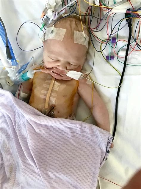 Powerful Pictures Show Strong Baby Recovering From Open