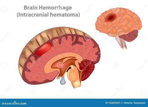 Hemorragia Cerebral Hematoma Intracraneal Ilustración del Vector