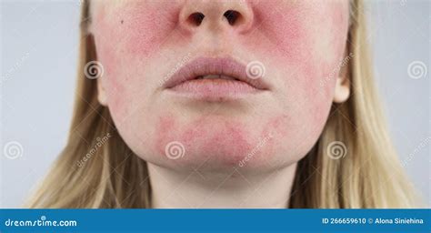 Rosacea Face The Girl Suffers From Redness On Her Cheeks Couperosis