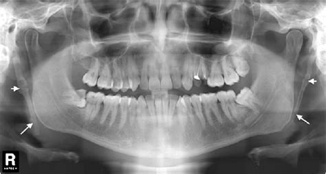 A 31 Year Old Asymptomatic Male With Calcified Stylohyoid Ligaments