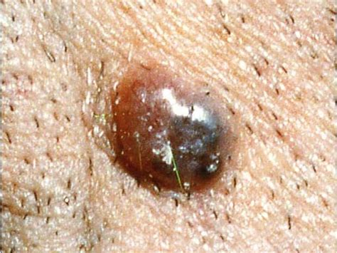 Skin Cancer Or Mole How To Tell Photo 1 Pictures Cbs News