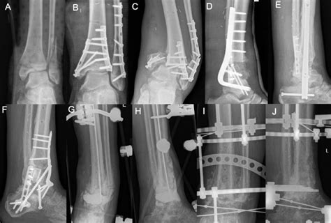 Nonunion After An Open Trimalleolar Ankle Fracture An Extended