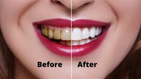 Great Tips To Whiten Your Teeth Naturally Youtube