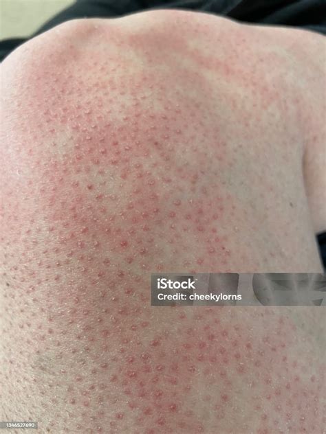 Hives Heat Rash Eai Erythema Ab Igne Heat Reaction On Knee Closeup