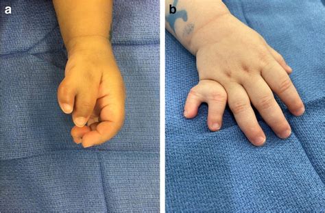 A Photograph Demonstrating Wassel Flatt Type Iv Preaxial Polydactyly In