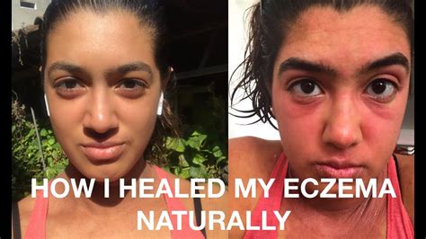 How I Healed My Eczema Naturally Youtube