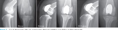Pdf Patellar Groove Replacement In Patellar Luxation With Severe
