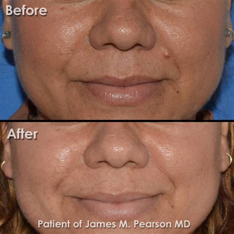 Photos Mole Removal Dr James Pearson Facial Plastic Surgery